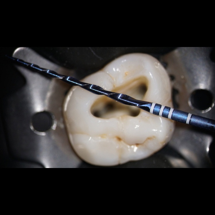 Dental endo files VDW reciproc blue Niti root canal files